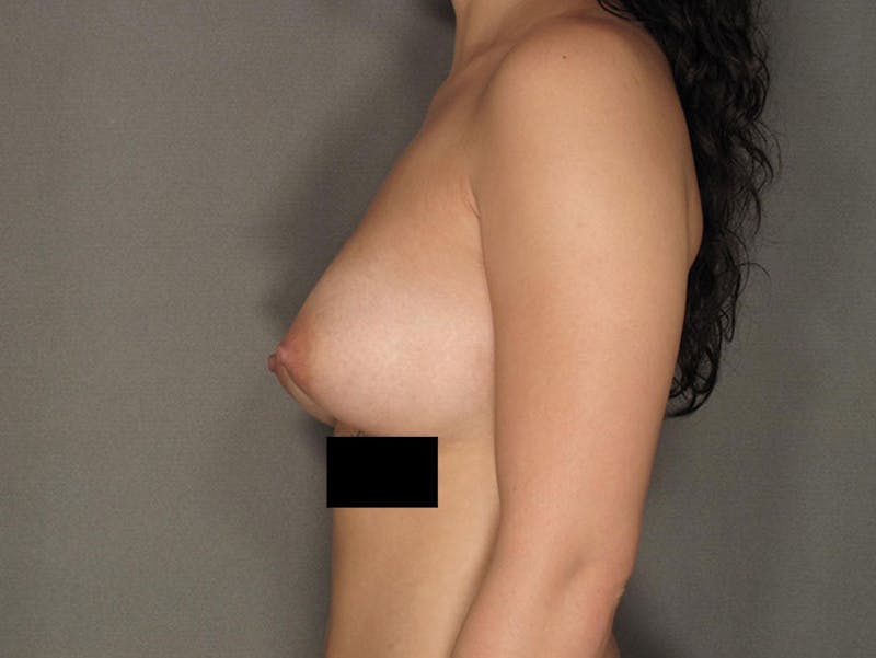 Breast Augmentation Before & After Gallery - Patient 120902545 - Image 6