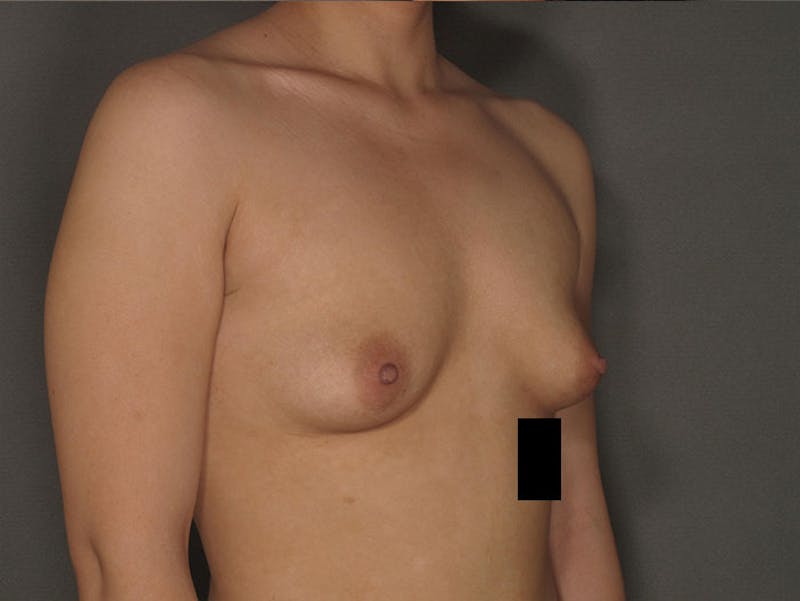 Breast Augmentation Before & After Gallery - Patient 120902545 - Image 7