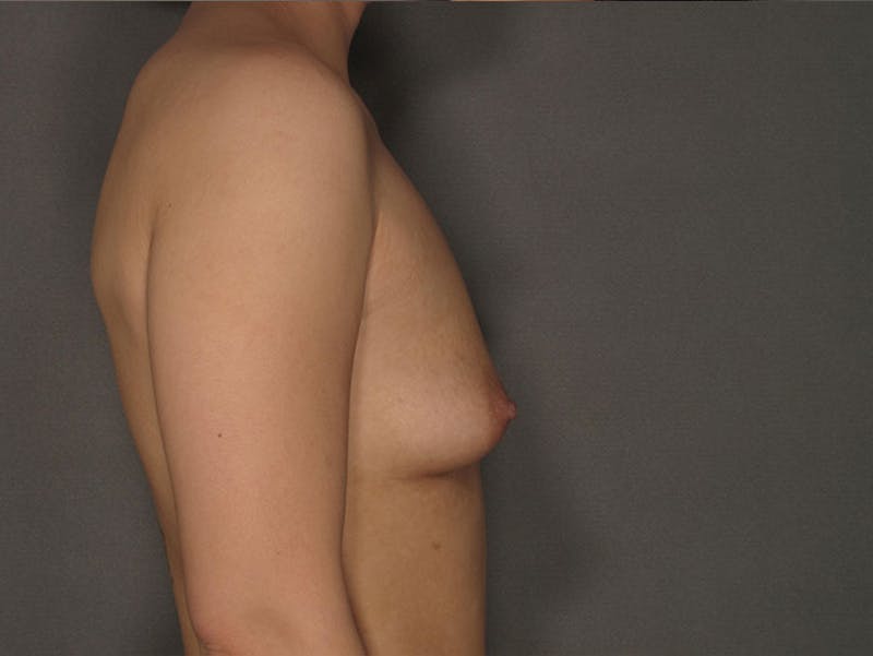 Breast Augmentation Before & After Gallery - Patient 120902545 - Image 9