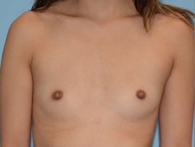 Breast Augmentation Before & After Gallery - Patient 120902546 - Image 1