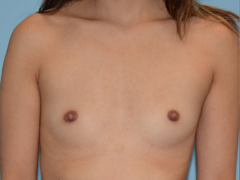 Breast Augmentation Before & After Gallery - Patient 120902546 - Image 1