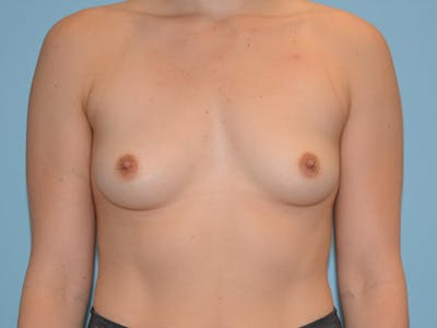 Breast Augmentation Before & After Gallery - Patient 120902555 - Image 1