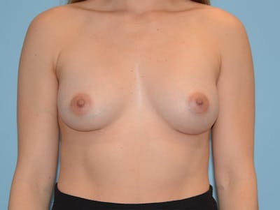 Breast Augmentation Before & After Gallery - Patient 120902555 - Image 2
