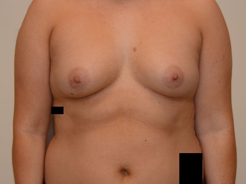 Breast Augmentation Before & After Gallery - Patient 120902565 - Image 1