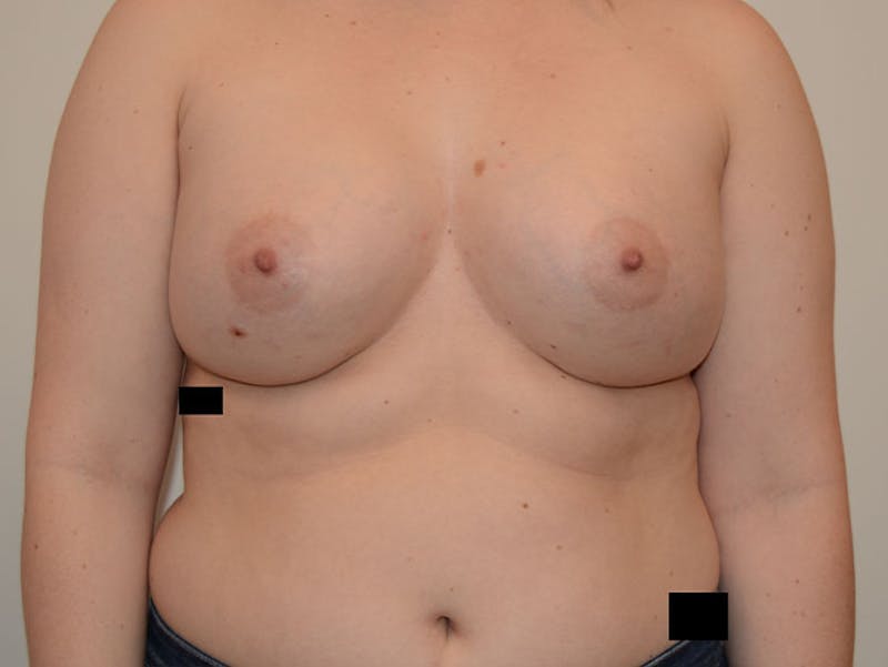Breast Augmentation Before & After Gallery - Patient 120902565 - Image 2