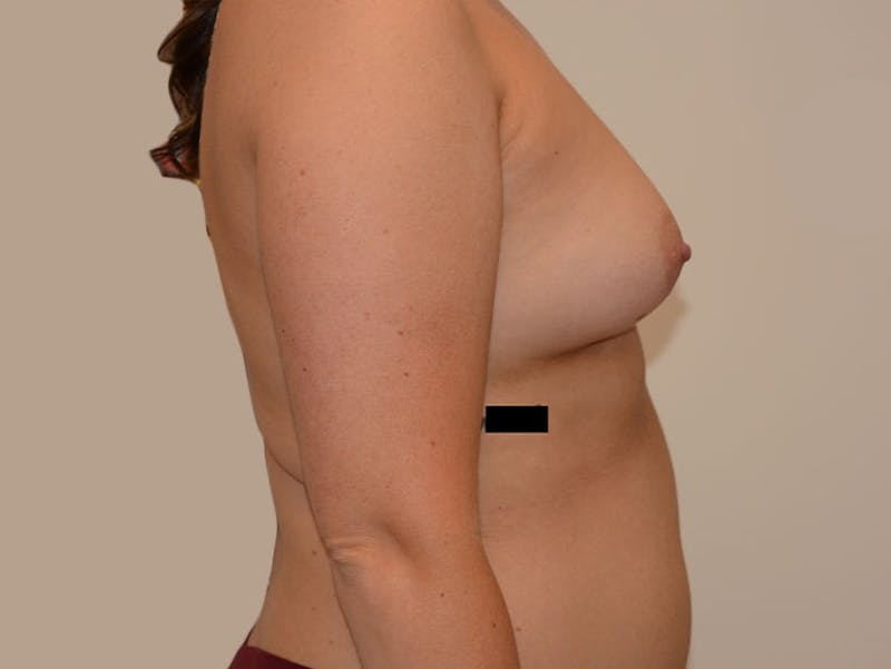 Breast Augmentation Before & After Gallery - Patient 120902565 - Image 3