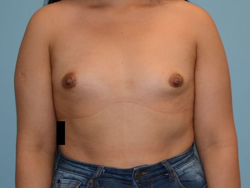 Breast Augmentation Gallery - Patient 120902571 - Image 1