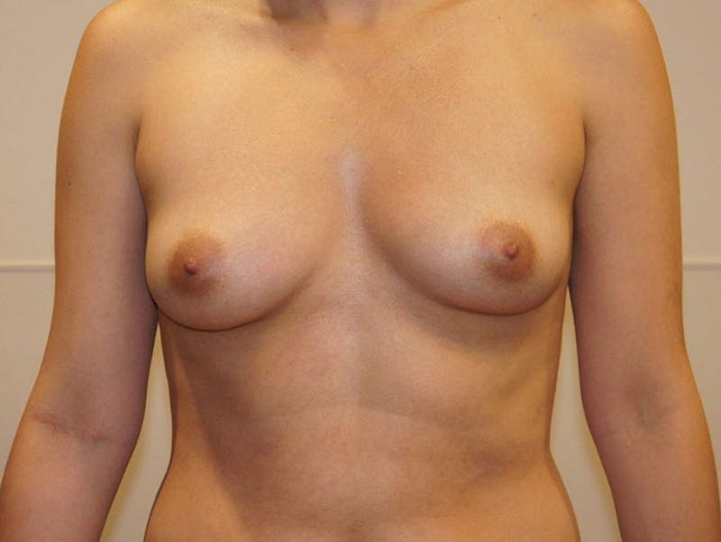 Breast Augmentation Before & After Gallery - Patient 120902576 - Image 1