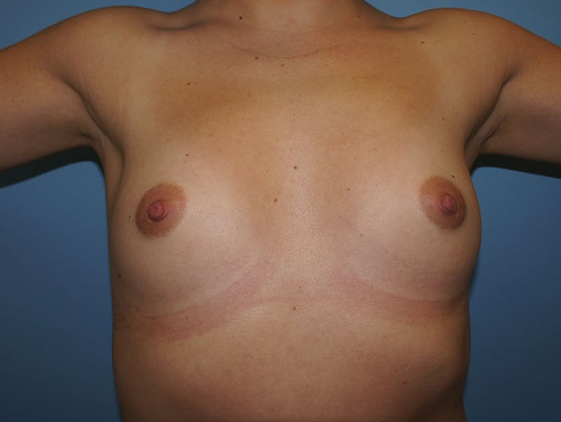 Breast Augmentation Gallery - Patient 120902580 - Image 1