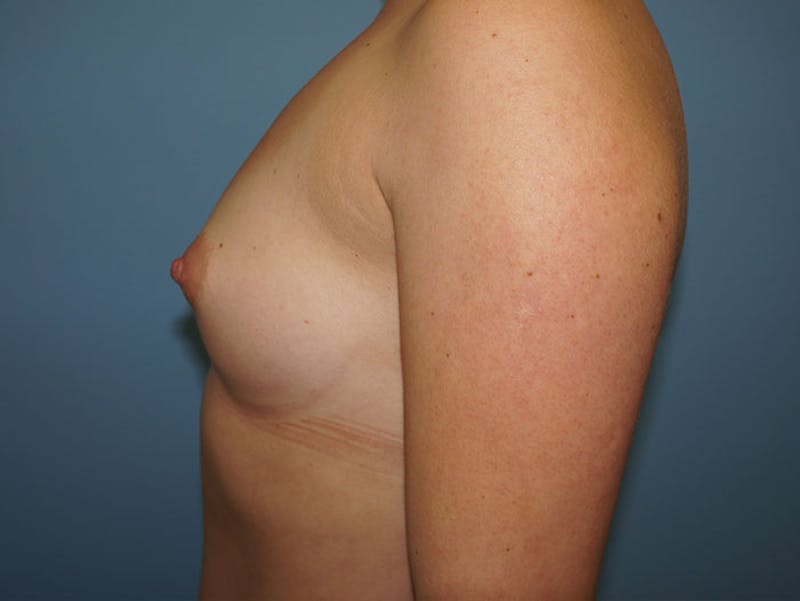 Breast Augmentation Gallery - Patient 120902580 - Image 5