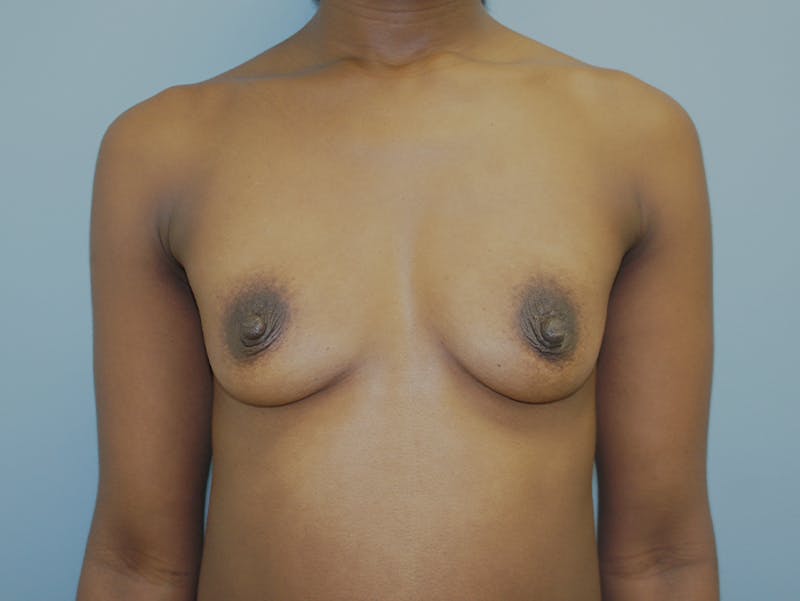 Breast Augmentation Gallery - Patient 120902587 - Image 1