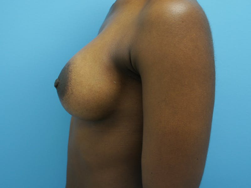 Breast Augmentation Before & After Gallery - Patient 120902587 - Image 6