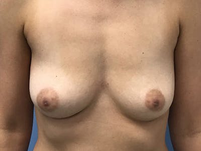 Breast Augmentation Before & After Gallery - Patient 120902592 - Image 1