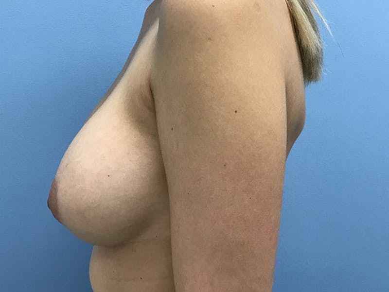 Breast Augmentation Before & After Gallery - Patient 120902592 - Image 6