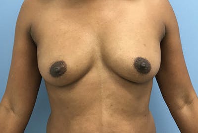 Breast Augmentation Before & After Gallery - Patient 120902595 - Image 1