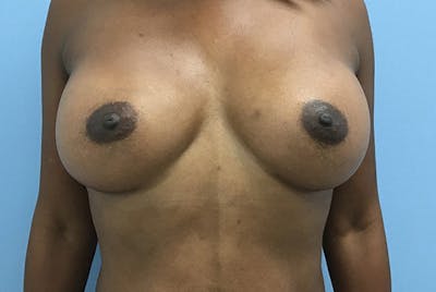 Breast Augmentation Before & After Gallery - Patient 120902595 - Image 2