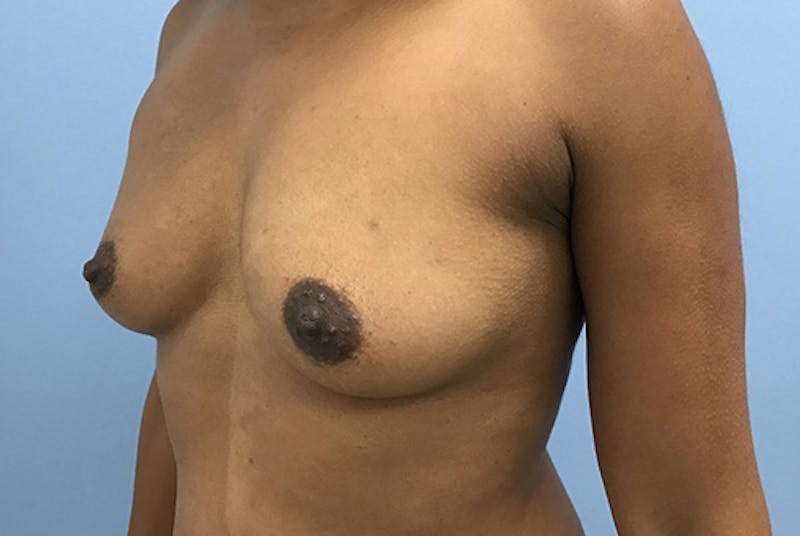 Breast Augmentation Before & After Gallery - Patient 120902595 - Image 3