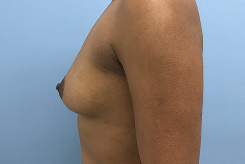Breast Augmentation Before & After Gallery - Patient 120902595 - Image 5