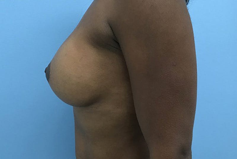 Breast Augmentation Before & After Gallery - Patient 120902595 - Image 6
