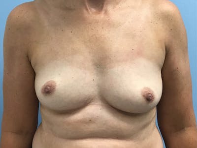 Breast Augmentation Before & After Gallery - Patient 120902598 - Image 1
