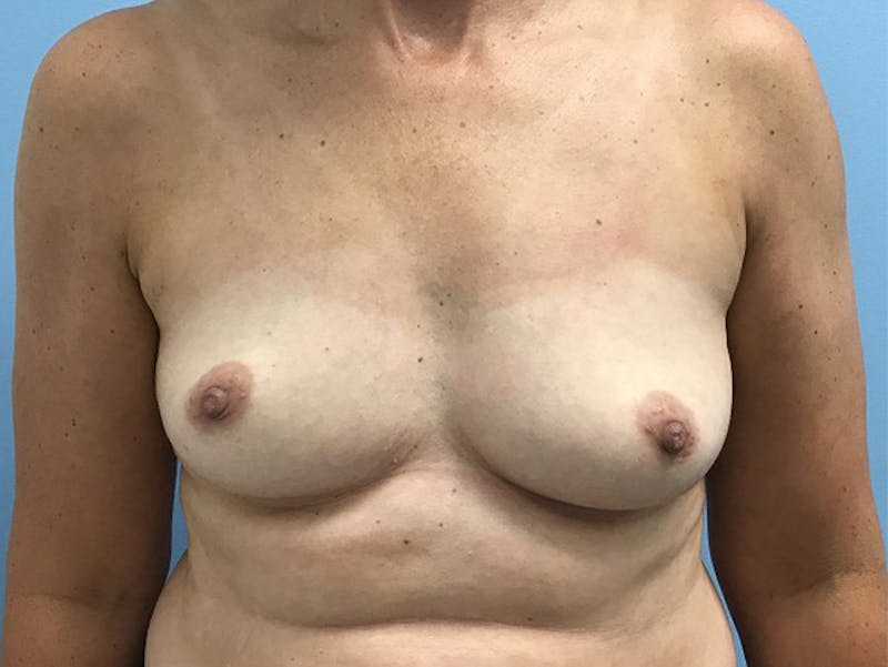 Breast Augmentation Before & After Gallery - Patient 120902598 - Image 1