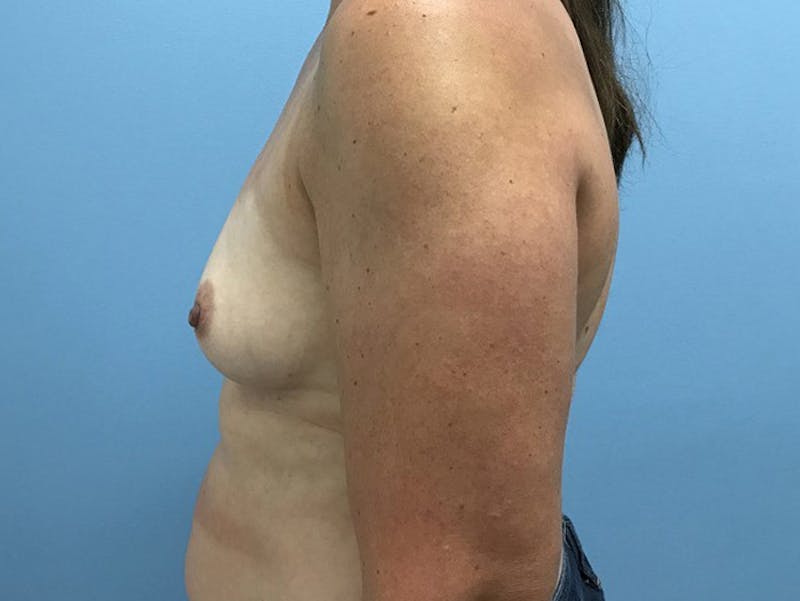 Breast Augmentation Before & After Gallery - Patient 120902598 - Image 5