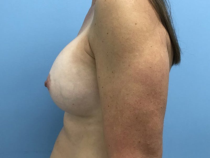 Breast Augmentation Gallery - Patient 120902598 - Image 6