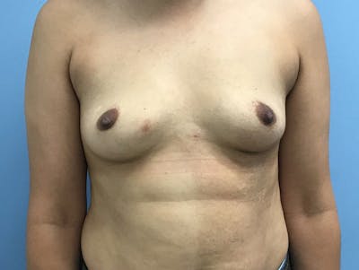 Breast Augmentation Gallery - Patient 120902603 - Image 1