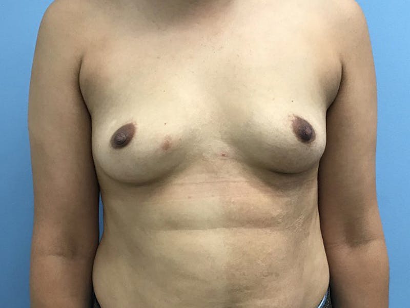 Breast Augmentation Before & After Gallery - Patient 120902603 - Image 1