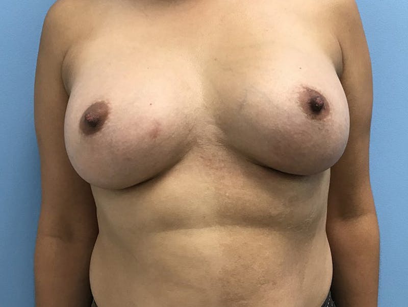 Breast Augmentation Before & After Gallery - Patient 120902603 - Image 2