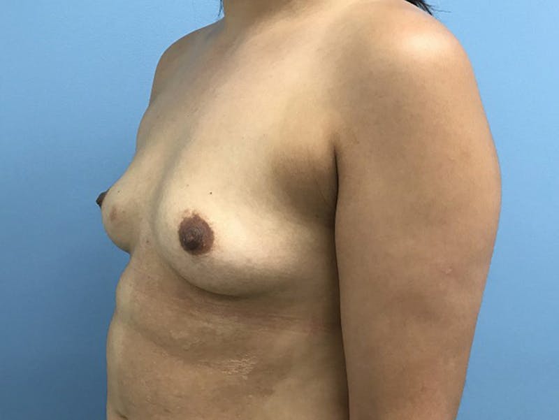 Breast Augmentation Before & After Gallery - Patient 120902603 - Image 3
