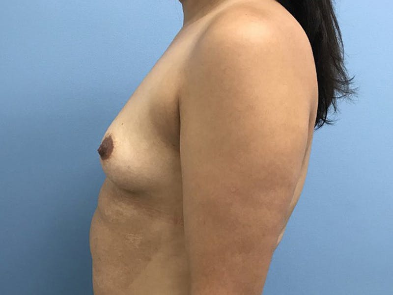 Breast Augmentation Before & After Gallery - Patient 120902603 - Image 5