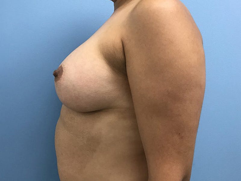 Breast Augmentation Before & After Gallery - Patient 120902603 - Image 6