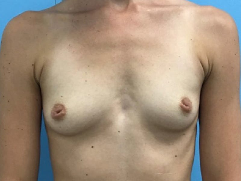 Breast Augmentation Before & After Gallery - Patient 120902607 - Image 1