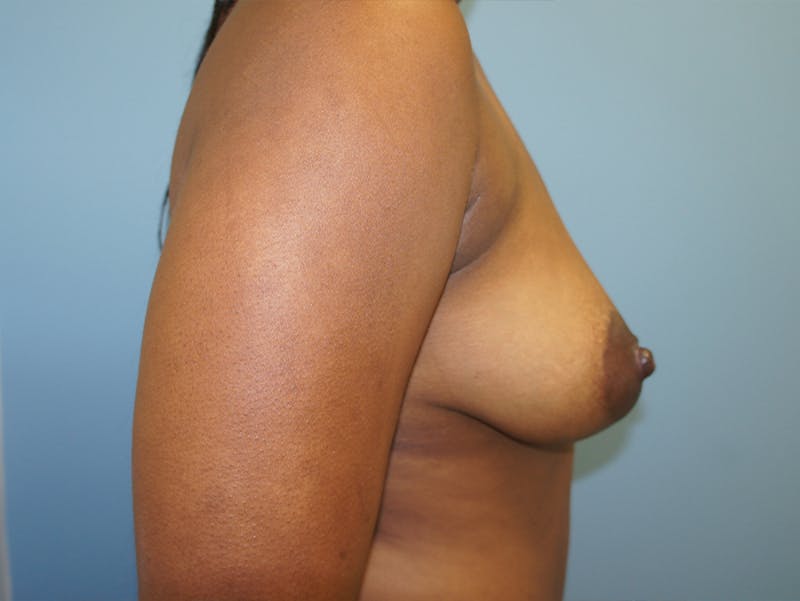 Breast Lift Before & After Gallery - Patient 120902700 - Image 5