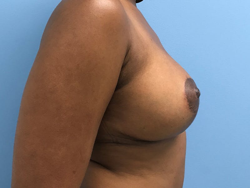 Breast Lift Before & After Gallery - Patient 120902700 - Image 6
