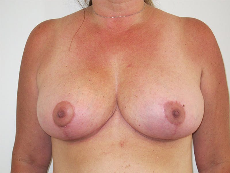 Breast Lift Gallery - Patient 120902703 - Image 2