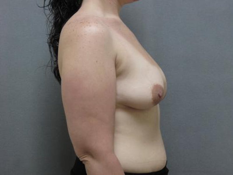 Breast Lift Gallery - Patient 120902710 - Image 3