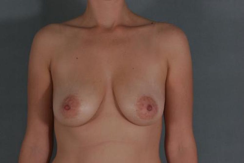 Breast Lift Before & After Gallery - Patient 120902733 - Image 1