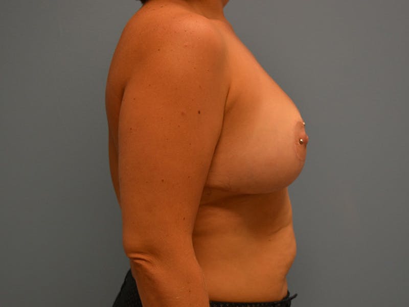 Breast Lift Before & After Gallery - Patient 120902754 - Image 8