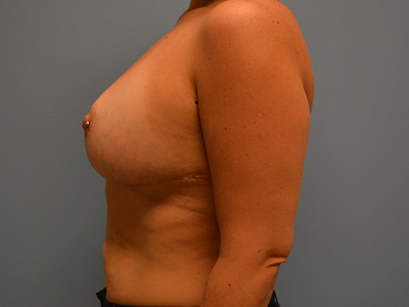 Breast Lift Gallery - Patient 120902754 - Image 10