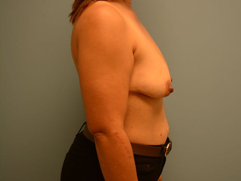 Breast Lift Before & After Gallery - Patient 120902759 - Image 3
