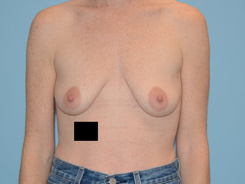 Breast Lift Before & After Gallery - Patient 120902762 - Image 1