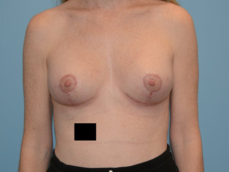 Breast Lift Before & After Gallery - Patient 120902762 - Image 2