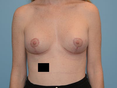 乳房提升前后图-患者120902762 -图2