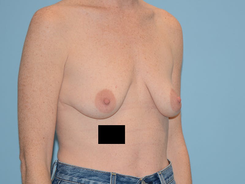 Breast Lift Before & After Gallery - Patient 120902762 - Image 3