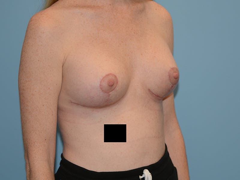 Breast Lift Gallery - Patient 120902762 - Image 4