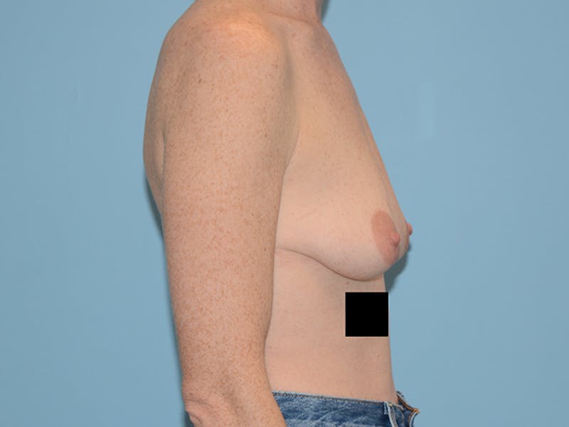 Breast Lift Gallery - Patient 120902762 - Image 5