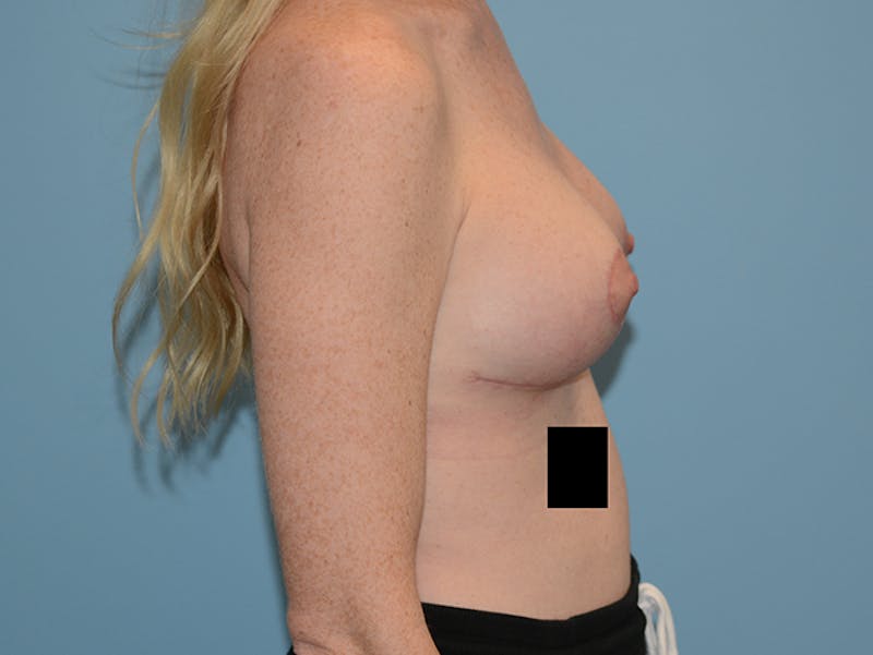 Breast Lift Before & After Gallery - Patient 120902762 - Image 6