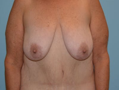乳房提升前和后画廊-病人120902784 -图像1